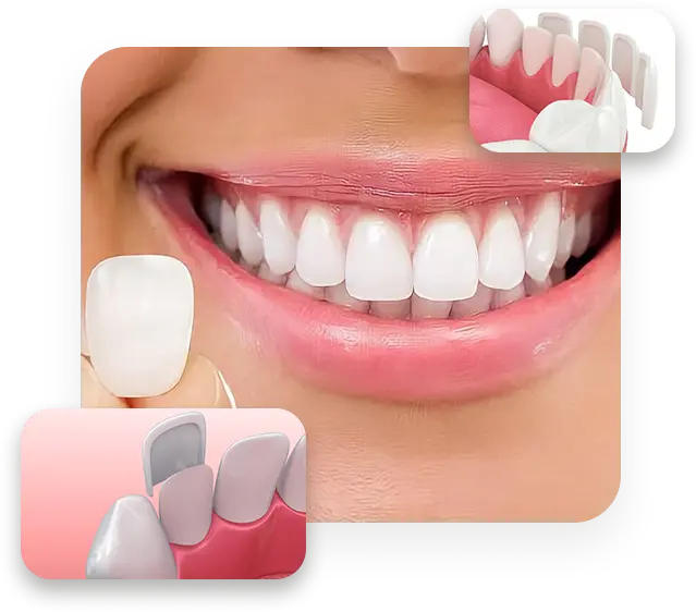 3 Itens Finais Lentes