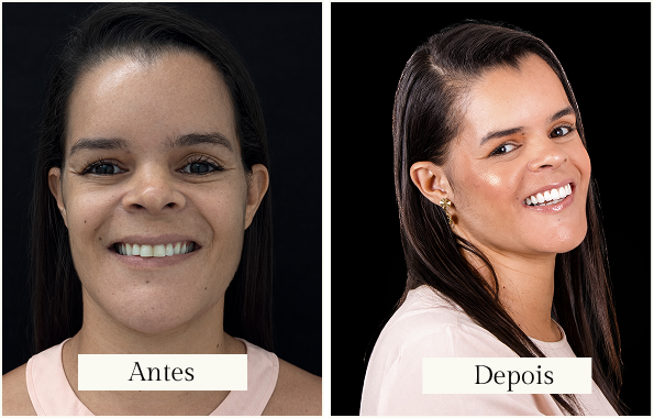 Antes E Depois1